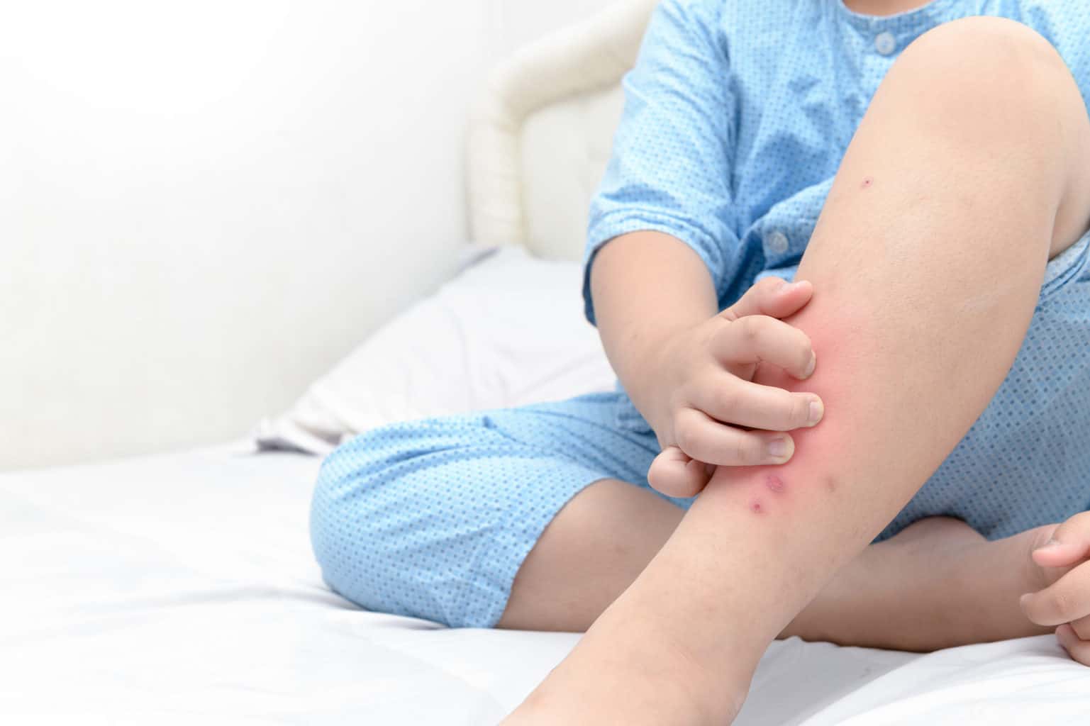 essential oils for bug bites on toddlers